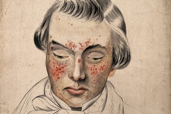 Illustration: Head of a man with a severe disease affecting his face by Christopher D' Alton, 1858

Source: http://www.jstor.g.sjuku.top/stable/community.24834473