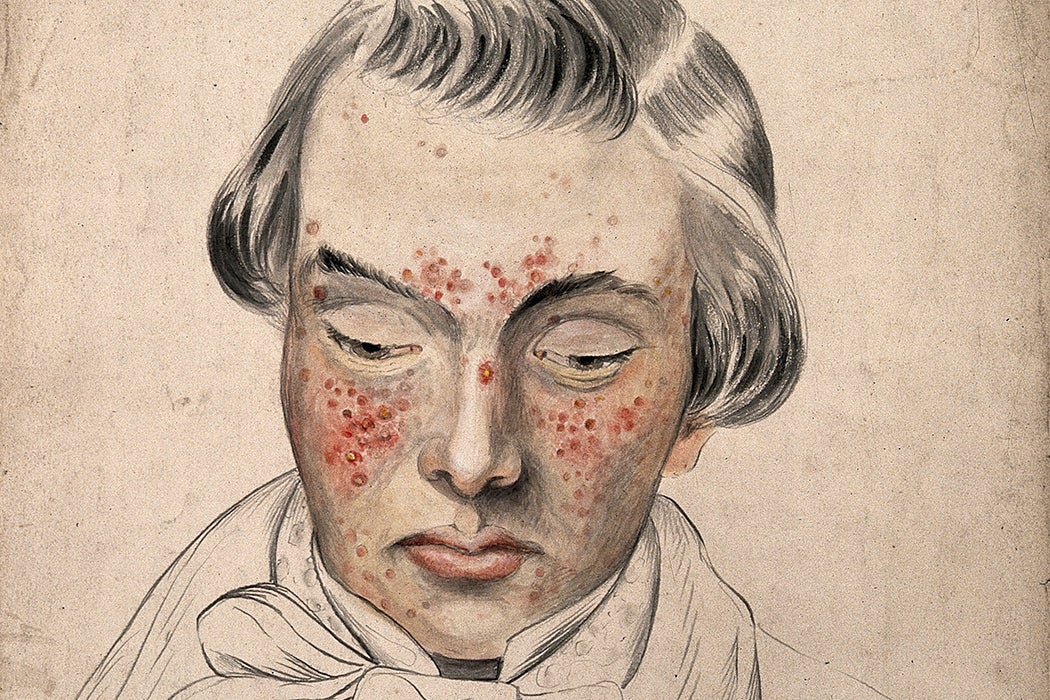 Illustration: Head of a man with a severe disease affecting his face by Christopher D' Alton, 1858

Source: http://www.jstor.g.sjuku.top/stable/community.24834473